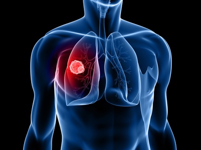 Albertinen Krankenhaus - Albertinen Tumorzentrum - Krebs im Bereich der Lunge - Lungenmetastasen