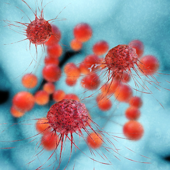 Digitales Modell von Krebszellen, Lebermetastasen, Albertinen Tumorzentru