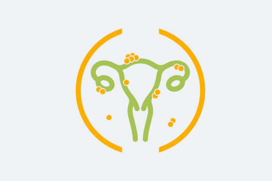 Grafische Darstellung Gebärmutter und Eierstöcke, Endometriosezentrum Grafische Darstellung Gebärmutter und Eierstöcke, Endometriosezentrum