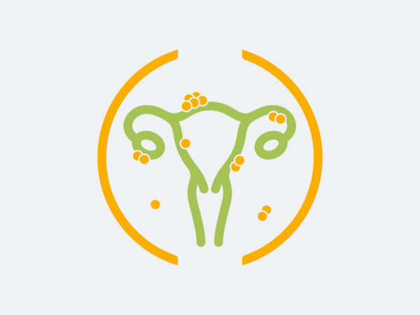 Grafische Darstellung Gebärmutter und Eierstöcke, Endometriosezentrum Grafische Darstellung Gebärmutter und Eierstöcke, Endometriosezentrum